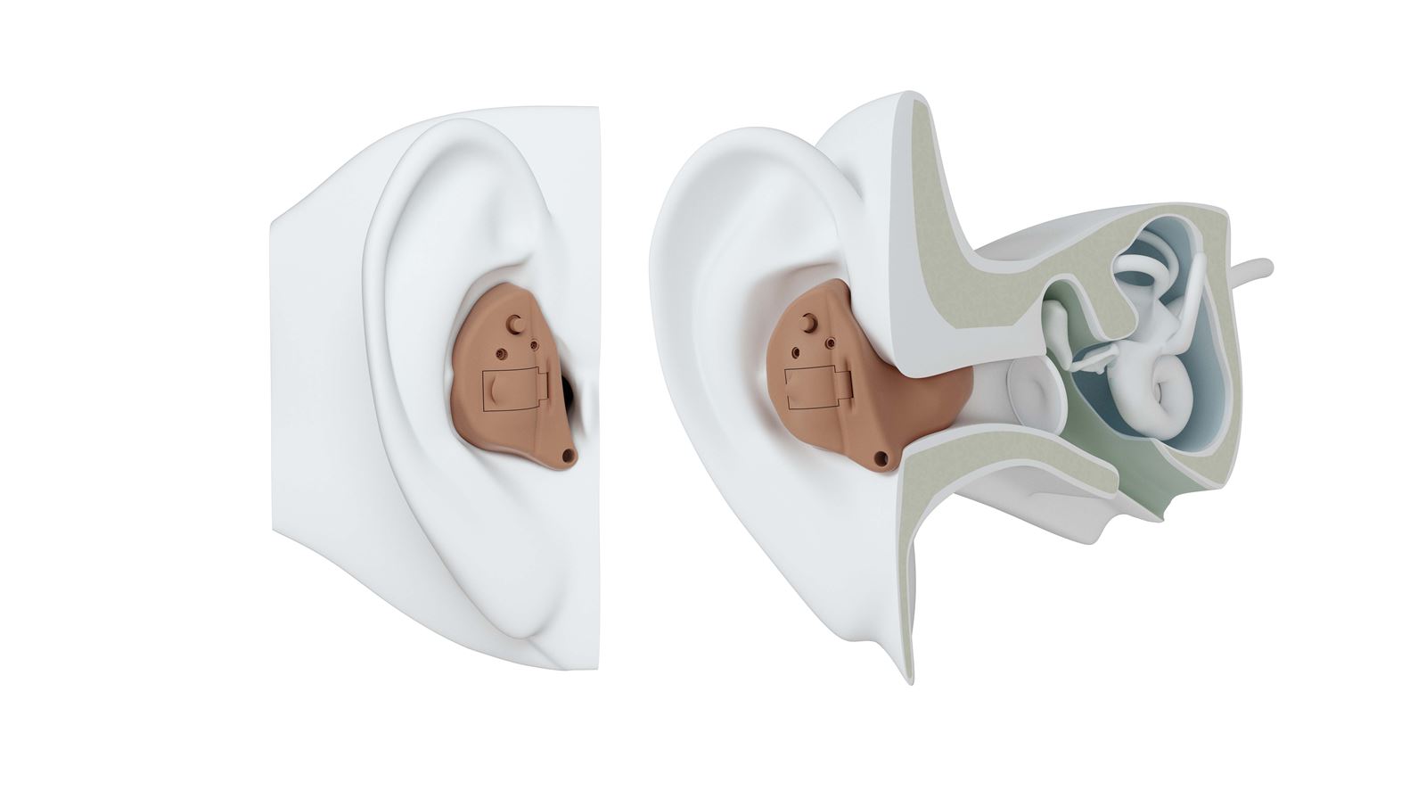 Custom ITE Hearing Aid